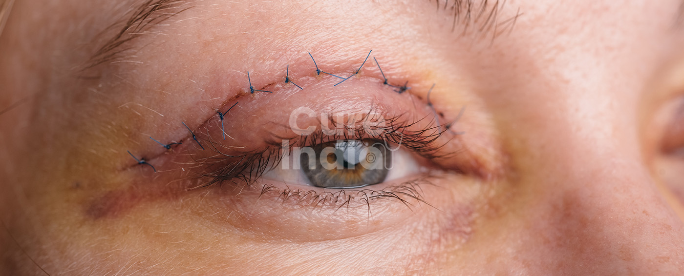 Blepharoplasty-Eyelid Sugery